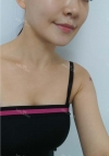 Accu & thread lift — Korea cost, reviews & before-after | MISOODA