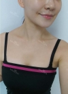 Accu & thread lift — Korea cost, reviews & before-after | MISOODA