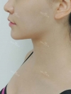 Accu & thread lift — Korea cost, reviews & before-after | MISOODA