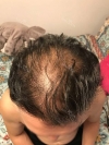 my hair is now so much thicker & fuller!! — Korea cost, reviews & before-after | MISOODA