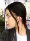 After 5 months of nose surgery — Korea cost, reviews & before-after | MISOODA