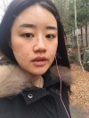 After 5 months of nose surgery — Korea cost, reviews & before-after | MISOODA