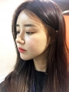 After 5 months of nose surgery — Korea cost, reviews & before-after | MISOODA