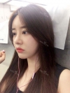 After 5 months of nose surgery — Korea cost, reviews & before-after | MISOODA