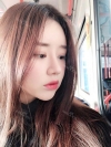 After 5 months of nose surgery — Korea cost, reviews & before-after | MISOODA