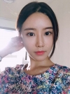 After 3 months of Eye, Nose, Fat grafting Surgery — Korea cost, reviews & before-after | MISOODA