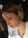 After 3 months of Eye, Nose Fat Grafting Surgery! — Korea cost, reviews & before-after | MISOODA