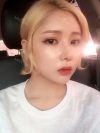 After 3 months of Eye, Nose Fat Grafting Surgery! — Korea cost, reviews & before-after | MISOODA