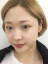After 3 months of Eye, Nose Fat Grafting Surgery! — Korea cost, reviews & before-after | MISOODA