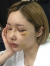After 3 months of Eye, Nose Fat Grafting Surgery! — Korea cost, reviews & before-after | MISOODA