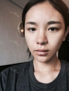 After 6 months of Eye, Breast, Fat grafting Surgery — Korea cost, reviews & before-after | MISOODA