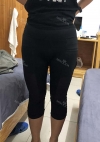 Thigh Liposuction+Calf Botox — Korea cost, reviews & before-after | MISOODA