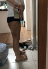 Thigh Liposuction+Calf Botox — Korea cost, reviews & before-after | MISOODA