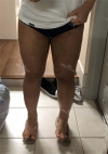 Thigh Liposuction+Calf Botox — Korea cost, reviews & before-after | MISOODA