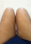 Thigh Liposuction+Calf Botox — Korea cost, reviews & before-after | MISOODA
