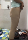 Thigh Liposuction+Calf Botox — Korea cost, reviews & before-after | MISOODA