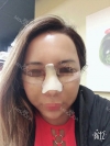 Revision Rhinoplasty, Fat graft, Skin Injection — Korea cost, reviews & before-after | MISOODA