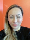 Revision Rhinoplasty, Fat graft, Skin Injection — Korea cost, reviews & before-after | MISOODA