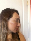 Revision Rhinoplasty, Fat graft, Skin Injection — Korea cost, reviews & before-after | MISOODA