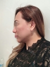 Revision Rhinoplasty, Fat graft, Skin Injection — Korea cost, reviews & before-after | MISOODA