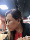 Revision Rhinoplasty, Fat graft, Skin Injection — Korea cost, reviews & before-after | MISOODA