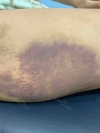 Motiva Breast Surgery at MBW — Korea cost, reviews & before-after | MISOODA