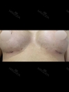 Motiva Breast Surgery at MBW — Korea cost, reviews & before-after | MISOODA
