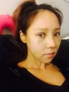Rhinoplasty & Double Eyelid Revision Surgery — Korea cost, reviews & before-after | MISOODA