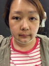 Two-Jaw Surgery & V-Line, Cinderella Circle Eye Surgery, Rhinoplasty, Lifting — Korea cost, reviews & before-after | MISOODA