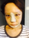 Rhinoplasty & Double Eyelid Revision Surgery — Korea cost, reviews & before-after | MISOODA