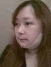 Two-Jaw Surgery & V-Line, Cinderella Circle Eye Surgery, Rhinoplasty, Lifting — Korea cost, reviews & before-after | MISOODA