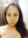 Rhinoplasty & Double Eyelid Revision Surgery — Korea cost, reviews & before-after | MISOODA