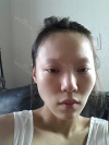 Rhinoplasty & Double Eyelid Revision Surgery — Korea cost, reviews & before-after | MISOODA