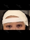 Girin: facial contouring, acculift, rhino, forehead lift, des, epi, fat graft — Korea cost, reviews & before-after | MISOODA