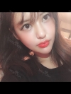 I got surgery at eyes, nose as reoperation and bon contour surgery, fat graft with Jewelry surgery center. — Korea cost, reviews & before-after | MISOODA