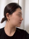 Nasal Bridge, Nasal Tip, Alar Base Resection — Korea cost, reviews & before-after | MISOODA