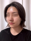 Nasal Bridge, Nasal Tip, Alar Base Resection — Korea cost, reviews & before-after | MISOODA