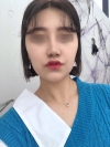 Nasal Bridge, Nasal Tip, Alar Base Resection — Korea cost, reviews & before-after | MISOODA
