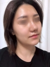 Nasal Bridge, Nasal Tip, Alar Base Resection — Korea cost, reviews & before-after | MISOODA