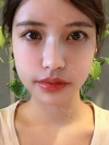 I got surgery at eyes, nose as reoperation and bon contour surgery, fat graft with Jewelry surgery center. — Korea cost, reviews & before-after | MISOODA