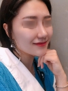 Nasal Bridge, Nasal Tip, Alar Base Resection — Korea cost, reviews & before-after | MISOODA