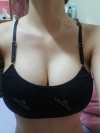 No longer a pre-teen body — Korea cost, reviews & before-after | MISOODA