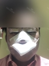 rhinoplasty (ear cartilage, silicone), ptosis correction and lateral canthoplasty — Korea cost, reviews & before-after | MISOODA