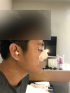 rhinoplasty (ear cartilage, silicone), ptosis correction and lateral canthoplasty — Korea cost, reviews & before-after | MISOODA