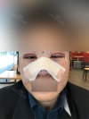 rhinoplasty (ear cartilage, silicone), ptosis correction and lateral canthoplasty — Korea cost, reviews & before-after | MISOODA