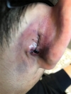 rhinoplasty (ear cartilage, silicone), ptosis correction and lateral canthoplasty — Korea cost, reviews & before-after | MISOODA