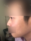 rhinoplasty (ear cartilage, silicone), ptosis correction and lateral canthoplasty — Korea cost, reviews & before-after | MISOODA