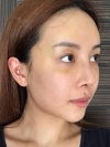Operation: Nose — Korea cost, reviews & before-after | MISOODA