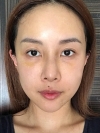 Operation: Nose — Korea cost, reviews & before-after | MISOODA
