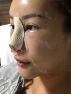 Operation: Nose — Korea cost, reviews & before-after | MISOODA